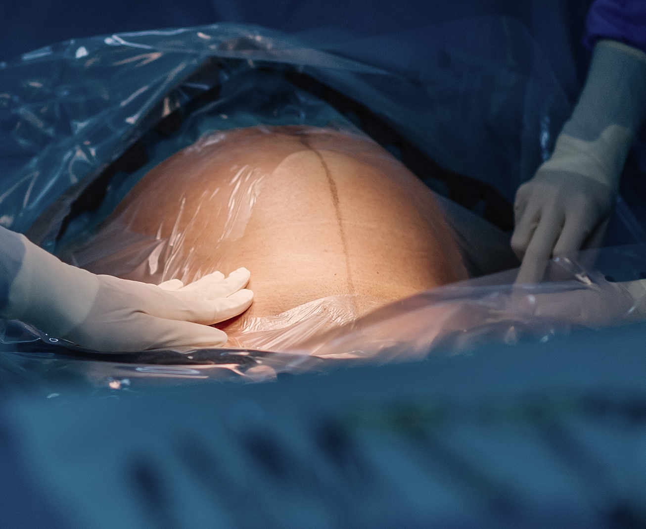 Responsabilite en matiere daccouchement condamnation dune clinique pour defaut dorganisation de la continuité obstetricale et chirurgicale des soins